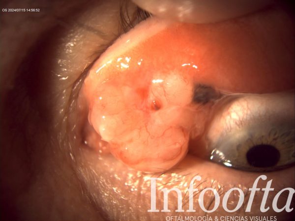 El enemigo de la superficie ocular: melanoma de conjuntiva