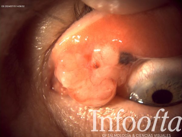 El enemigo de la superficie ocular: melanoma de conjuntiva