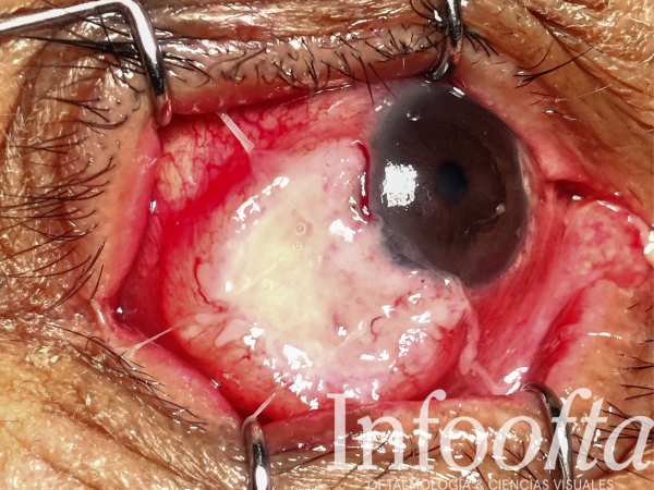 Fotografía clínica oftalmológica, mostrando ojo con afectación ocular neoplasia escamosa de la superficie ocular