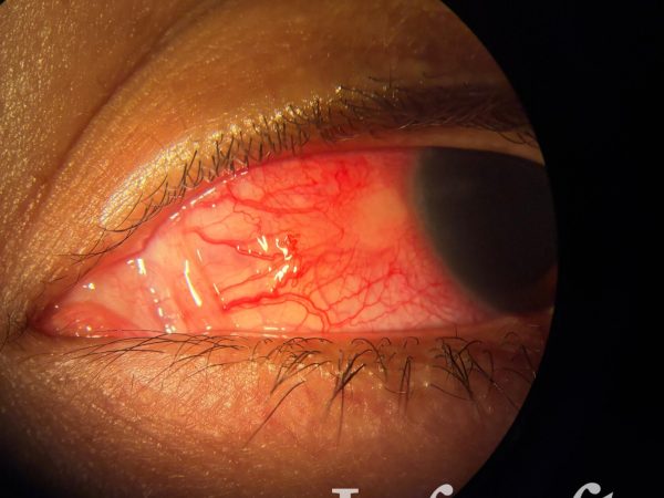 Fotografía clínica del mes_Vol.11_Escleritis nodular anterior
