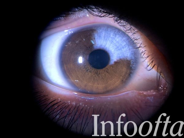 Ojo con heterocromía de iris, ojos color café y azul