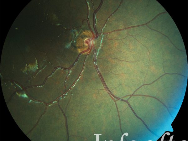 Hipoplasia/ Agenesia de nervio óptico. Fotografía clínica