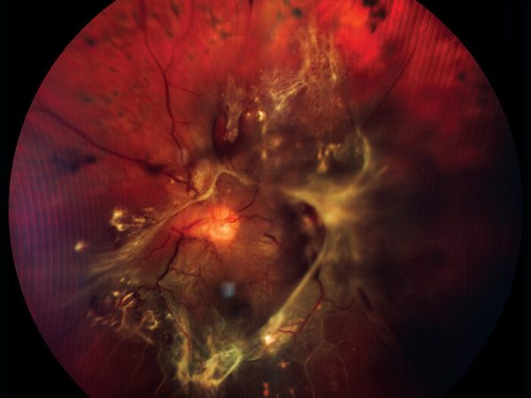 Desprendimiento de retina, procedimiento de oftalmología, fotografía clínica