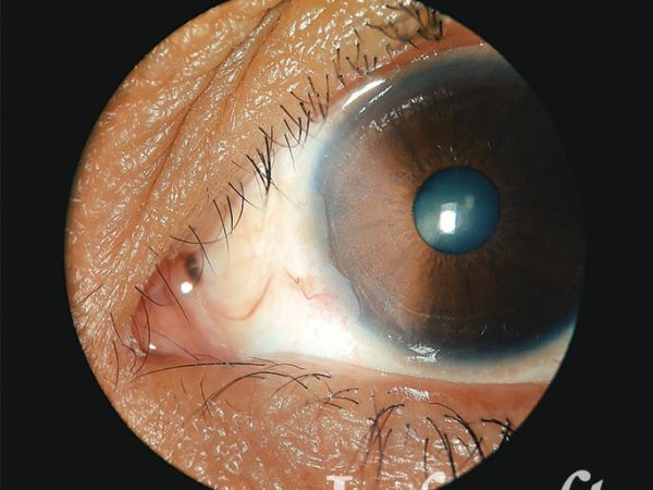 Fotografía de ojo con neoplasia escamosa de superficie ocular visto de cerca