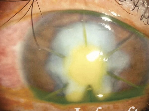 Fotografía de un ojo enfermo con queratitis fúngica