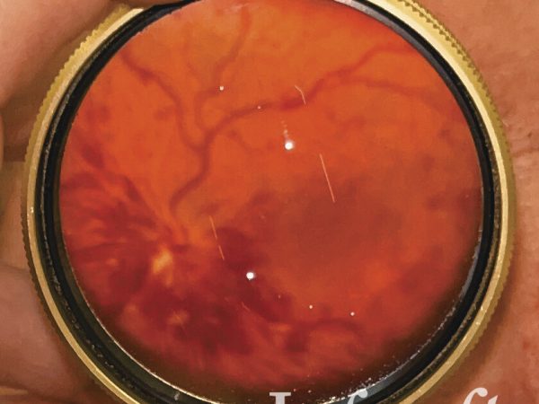 obstrucción vena central de la retina