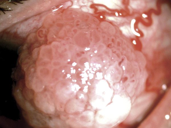 Lesión en superficie ocular clínica en paciente femenino