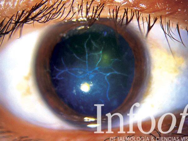 Paciente con distrofia corneal en lattice, daño ocular, afección de los ojos