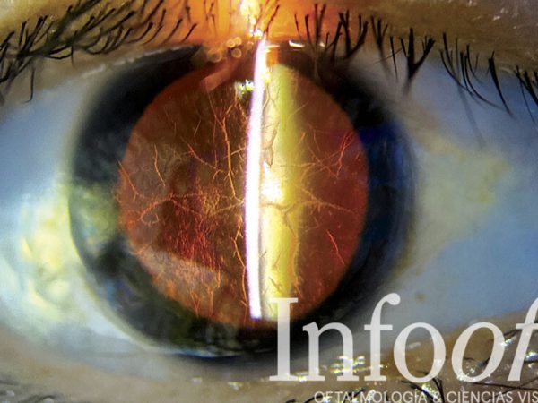 distrofia corneal, imagen clínica con técnica de retroiluminación
