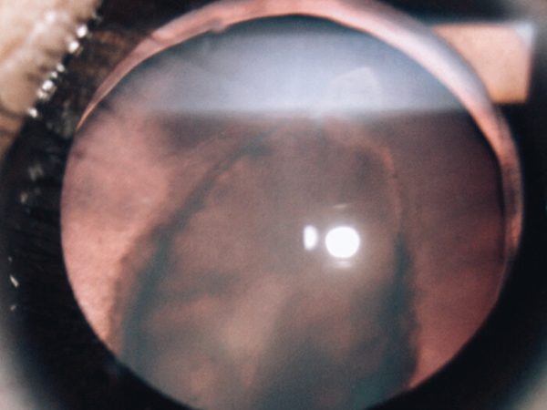 lenticono posterior, afección ocular, fotografía clínica