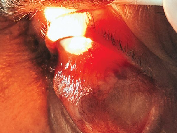 tumor de colisión, padecimiento ocular, fotografía clínica