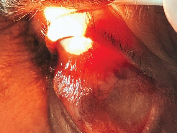 tumor de colisión, padecimiento ocular, fotografía clínica